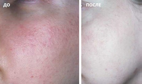 Устранение сосудистых нарушений на коже лица с помощью насадки Lumecca SR 515/580