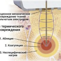 Исследование отсроченных эффектов в мягких тканях человека в ответ на применение фракционного микроигольчатого радиочастотного воздействия Morpheus8. Гистологическое и иммуногистохимическое исследование
